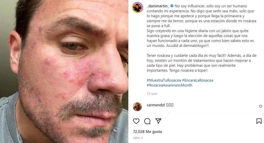 dani martin rosacea