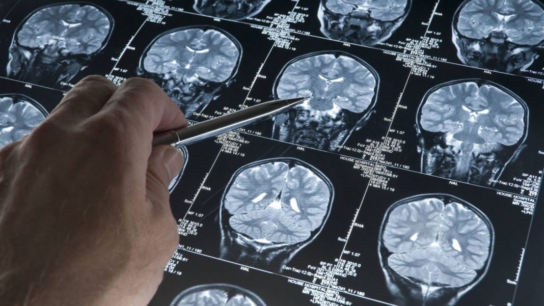 ¿Qué datos arrojó la investigación sobre el Alzheimer?