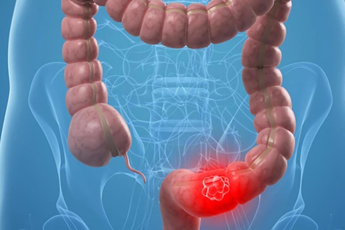 Quién debe someterse a la detección del cáncer colorrectal