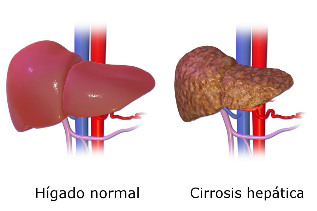 estigma enfermedades higado