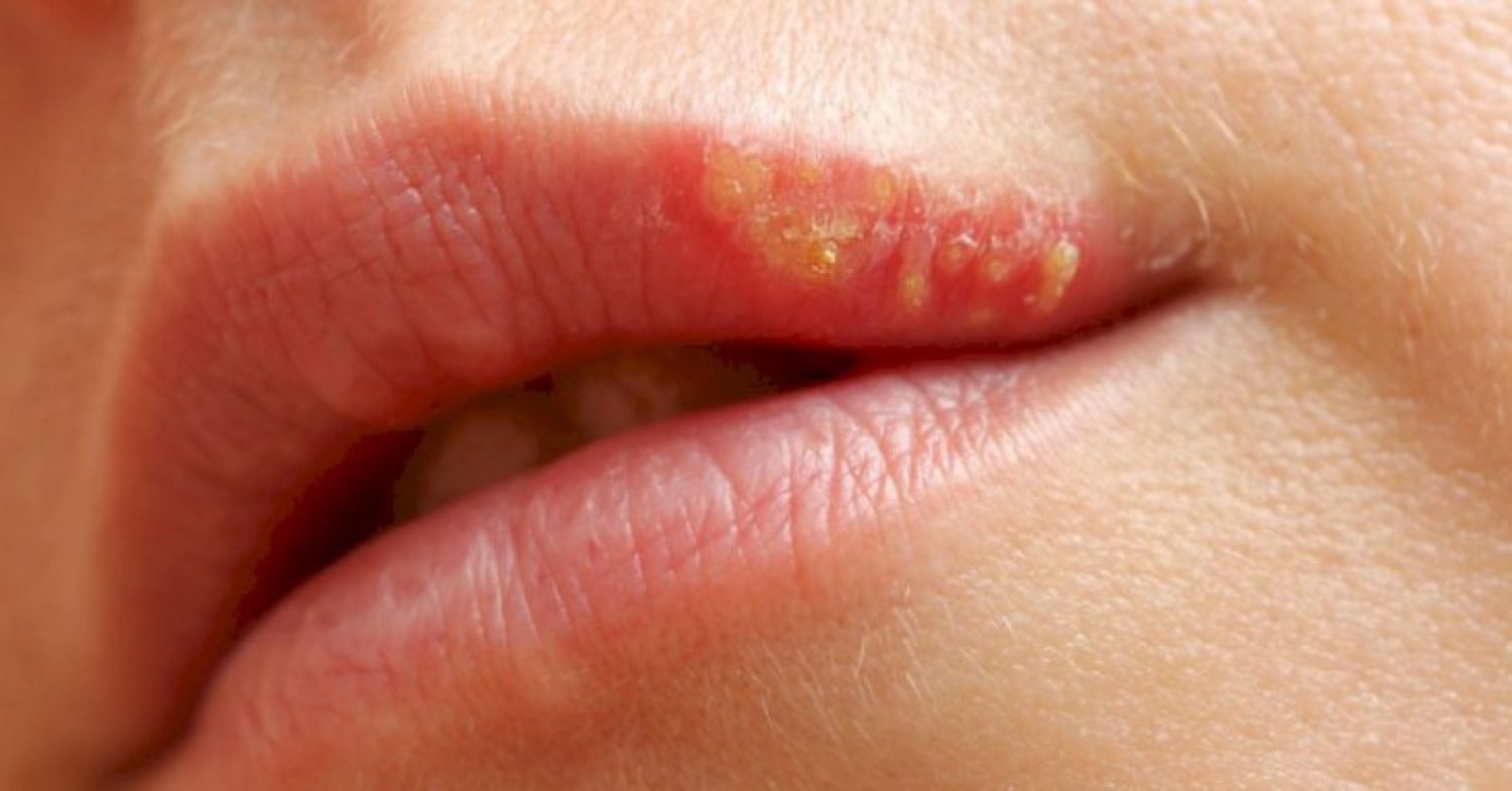 Cuidado profesional para el herpes labial