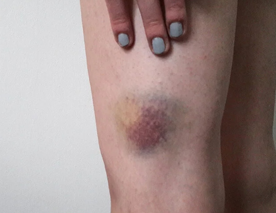 HEMATOMAS: ARNICA, EL REMEDIO NATURAL POR EXCELENCIA 