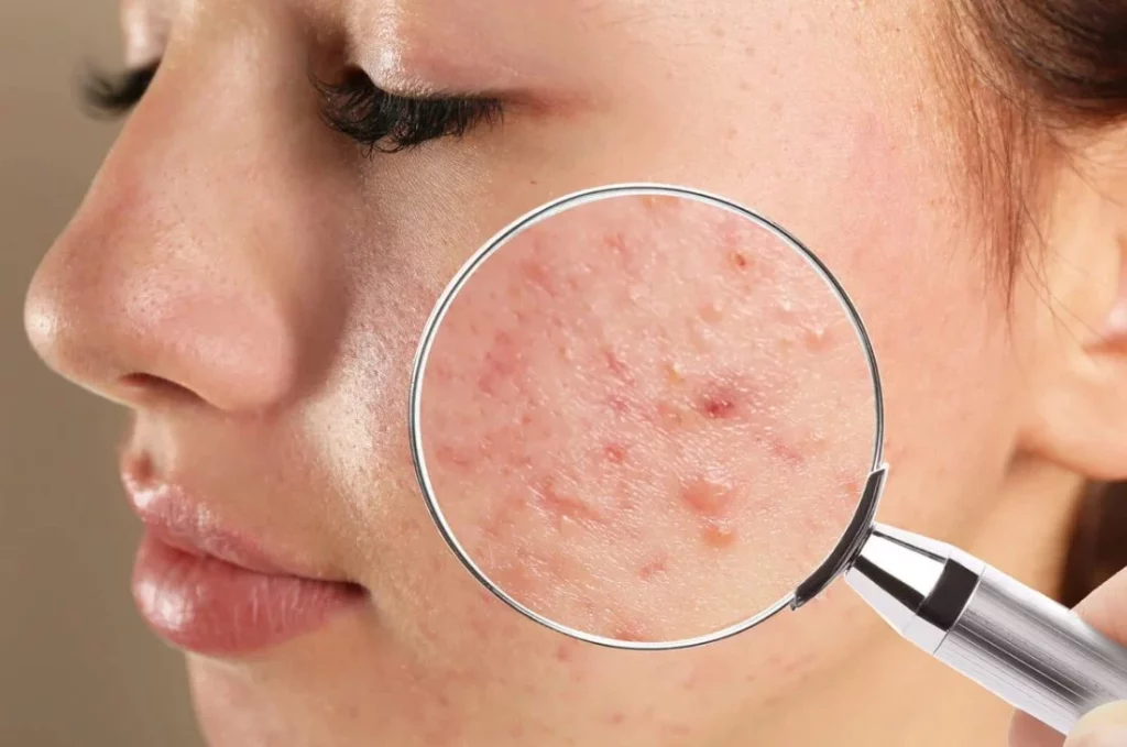 El error que está provocando ese acné en tu cutis que no puedes eliminar: Cómo evitarlo