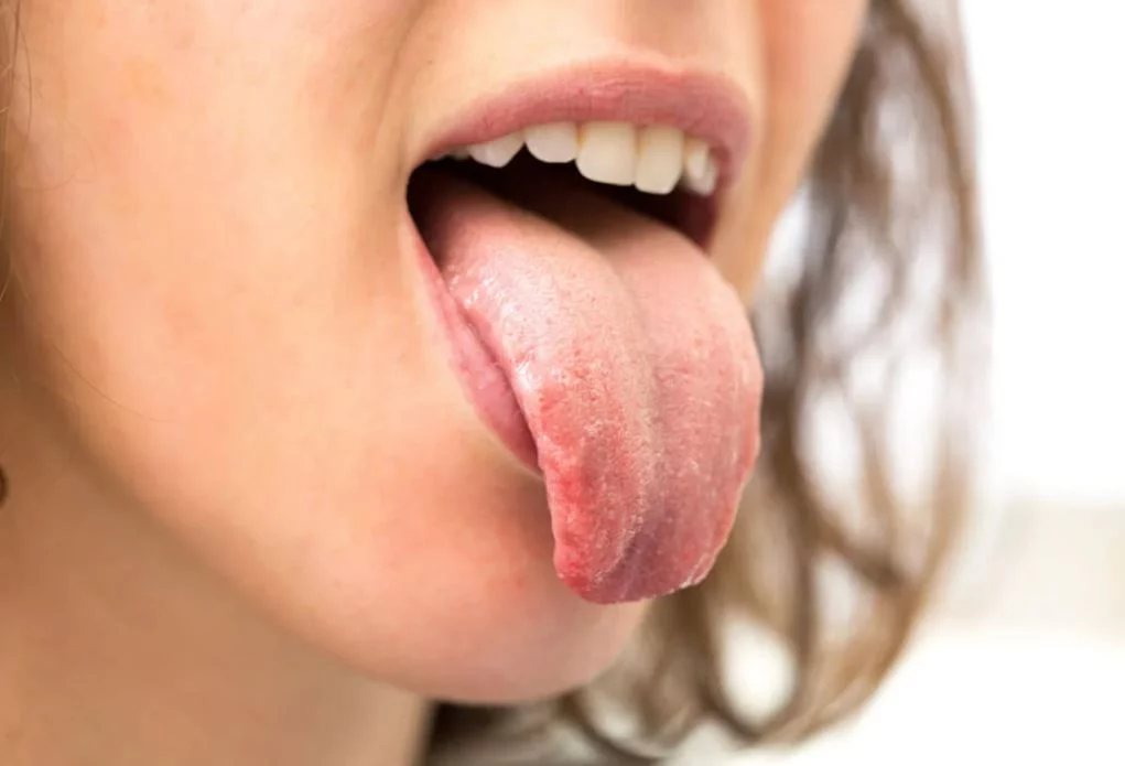 Este síntoma en la boca puede convertirse en la detección temprana de diabetes