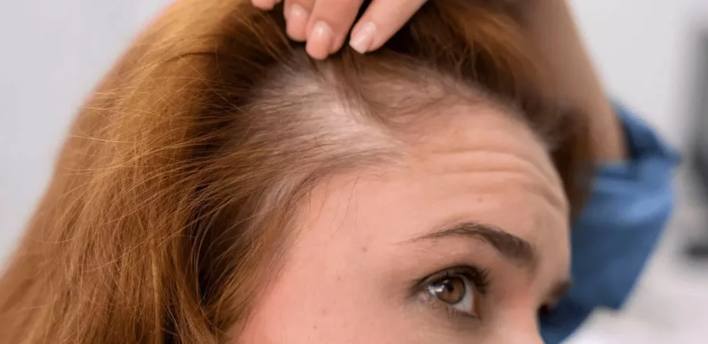 Si la caída del cabello tiene estas características, la atención médica es urgente