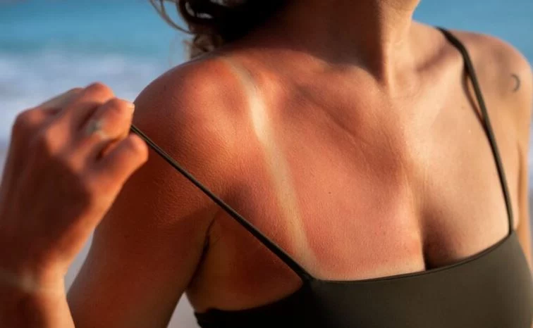 ¿Si no existe el callo solar, cómo debo cuidarme la piel?