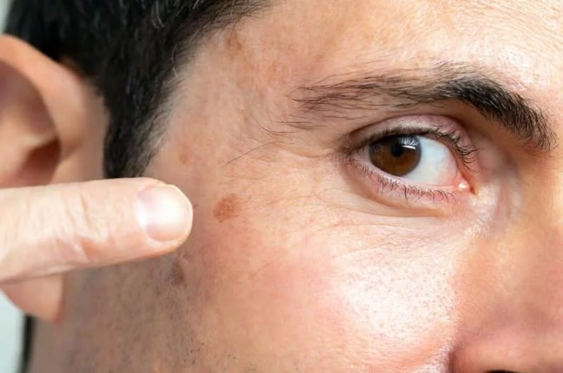¿Cuáles son las señales que podrían indicar un cáncer de piel?